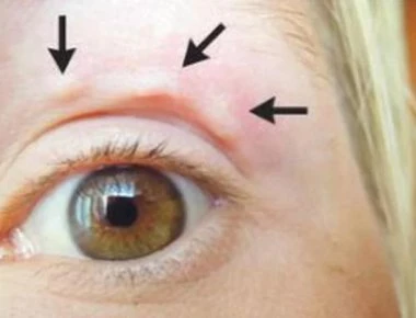 Αυτό το περίεργο εξόγκωμα στο μάτι της δεν φαντάζονταν τι ήταν τελικά!